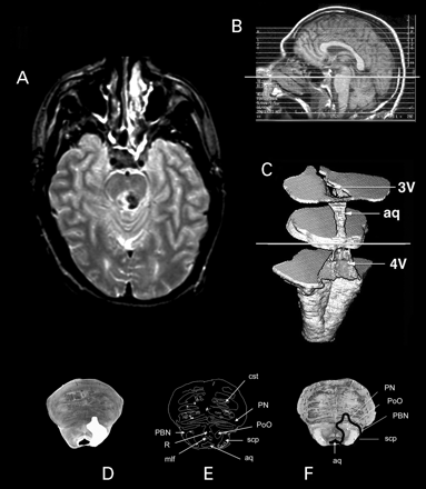 Fig. 3 Methods. (A) In our study, we first charted the lesion territory on patient MRIs. Using the scout scans (B), three‐dimensional reconstruction of the brainstem MRIs (C) and the characteristic shape of brainstem landmarks on each horizontal image, we found the corresponding 4.7 T template MRI (D) obtained from the control brainstem specimen. Once the boundaries of lesions were transferred onto the template MRIs (E), these were aligned in parallel to the histological sections (F) that were obtained from the template brainstem, and an inference was made about the identity of nuclei that fall within the lesion territory. Note the high resolution of the 4.7 T MRIs.