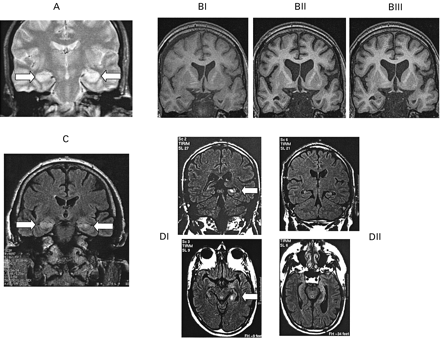 Fig. 2 MRI. (A) Case 1: T2‐weighted MRI showing bilateral hippocampal signal change (arrows) at disease onset. (B) Case 2: T1‐weighted coronal MRIs are shown from three time‐points: (BI) April 2002; (BII) October 2002; and (BIII) April 2003. Between scans BI and BII marked global decline in cerebral volume definitely, but not exclusively, involving the medial temporal lobes. Scan BIII shows little, if any, progression relative to BII, suggesting that ongoing excess volume loss had declined or halted, coincident with the improvement in clinical state and subsequent to treatment with plasma exchange. Concurrent FLAIR (fluid‐attenuated inversion recovery) imaging (not shown) revealed initial medial temporal lobe signal change, which had reduced by scan BII, and was no longer present by scan BIII. (C) Case 8: FLAIR coronal MRI at onset is shown, revealing signal change affecting anterior temporal lobe structures including each hippocampus (arrows). (D) Case 10: coronal and axial FLAIR images showing increased signal of the left hippocampus (arrow) 6 months after the onset of symptoms (DI), and increased signal and volume loss in both hippocampi, more pronounced on the left (arrows), 6 months later (DII).