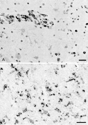 Fig. 3 Histopathology of the stereotactic biopsy of the left amygdala of Case 10. (A) Immunohistochemical staining for CD45 shows perivascular and parenchymal positive round cells (lymphocytes). (B) Staining for CD68 indicates diffuse microglial activation. Bars: 30 µm.