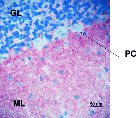 Fig. 4 Detection of VGKC‐Abs by routine indirect immunohistochemistry. All patients’ sera were negative for paraneoplastic antibodies but the five with the highest VGKC‐Ab titres (>2000 pM) produced a characteristic pink staining pattern on rat cerebellar neurons, binding strongly to the molecular layer and sparing the Purkinje cells. Two of the cases (1 and 3) were diagnosed during routine paraneoplastic screening by this characteristic staining pattern. PC = Purkinje cells; ML = molecular layer; GL = granular layer. Original magnification ×400.