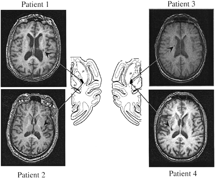 Fig. 1 T1 MRIs from the four patients studied. The arrows indicate the lesion sites. The diagrams at the centre show the location of the pyramidal tract fibres originating in M1 in the primate brain according to Morecraft et al. (2002). See Fries et al. (1993) for similar information in humans.