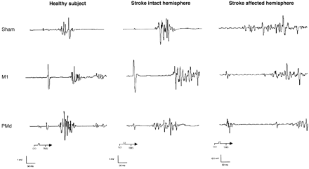 Fig. 3 Representative EMG recordings from contralateral FDI muscle with sham, M1 and PMd stimulation in a healthy volunteer and in Patient 1. Note that contralateral SRTs were delayed by stimulation of M1 in the healthy volunteer and by stimulation of M1IH and M1AH of the patient relative to sham. Stimulation of PMdAH produced a marked delay in contralateral SRT in the affected hand of the stroke patient, but did not affect contralateral SRT after stimulation of any PMd in a healthy volunteer nor after stimulation of PMdIH in the patient.
