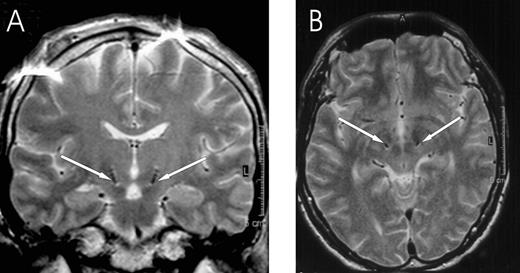 Fig. 1 Localization of DBS electrodes at the level of contact pair 12 in the postoperative MRI of Case 4 (A coronal, B axial MRI section; artefact in A at cortical level). Both are symmetrically placed within STN. Arrows point to the DBS electrode artefacts.