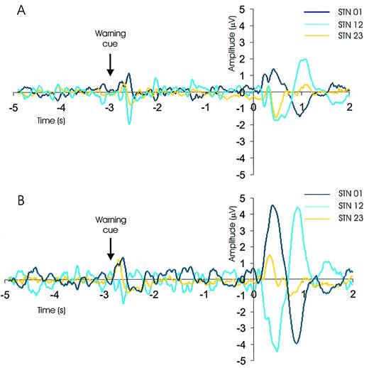 Fig. 9 Example of go ERPs in one representative subject (Case 2) recorded from the three contact pairs of the right (A) and left (B) DBS electrode (STN 01 was the most caudal and STN 23 was the most rostral contact pair). Raw activity was averaged across trials of the same warning cue laterality and aligned to the go cue onset at t = 0 s. ERP polarity reversal is present at contact 1 on both sides, with highest peak‐to‐peak amplitude of the ERP at STN 12.