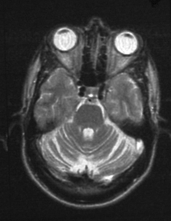 Fig. 1 Axial T2 MRI in patient 3 showing cerebellar atrophy.