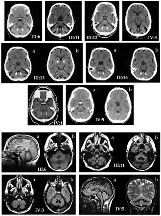 Fig. 2 Neuroradiology. Top three rows: non‐contrast axial brain CT scans on eight affected family members, showing dentate calcification in all, and pancerebellar atrophy in most. Cuts at two levels of the dentate are shown for III:16 and IV:5. Only one individual showed obvious pallidal calcification (III:13b); very slight pallidal calcification was seen in one other case (IV:3). Ages at examination range from 38 (IV:5) to 72 (III:6) years. Bottom two rows: non‐contrast brain MRI scans of four affected family members. III:6: T1 sagittal sequence (a) showing mild vermal atrophy with normal brainstem, and axial proton density image (b) showing low dentate signal. III:11, IV:3: axial proton density images showing inferior olivary hypertrophy (a), and low dentate signal (b). IV:5: proton density sagittal image (a) showing mild vermal atrophy and normal brainstem, and T2 coronal image showing low dentate signal and mild cerebellar atrophy (b). 