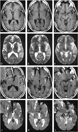 Fig. 2 Images of a 54‐year‐old man with infarction of the left middle cerebral artery territory, illustrating the different spatial distribution of the USPIO enhancement on T1‐weighted (A–C and G–I) versus T2*‐weighted images (D–F and J–L). Non‐enhanced images 5 days after stroke display slight swelling of the infarcted area with hypointense signal on T1‐weighted images (A–C) and hyperintense signal on T2*‐weighted images (D–F). At 48 h after USPIO infusion (G–L) T1‐weighted images show hyperintense parenchymal enhancement (G–I), whereas T2*‐weighted images display signal loss mainly associated with blood vessels (J–L). High magnification insets clearly demonstrate the differential distribution of the signal alterations on T1‐ (G–I) and T2*‐weighted images (J–L).