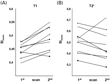Fig. 3 ROI measurements of USPIO‐induced signal changes in infarcted parenchyma on T1‐ (A) and T2*‐weighted images (B) obtained 24–36 h (first scan) and 48–72 h (second scan) after USPIO infusion. SInorm represents the signal intensity of USPIO‐enhancement normalized to the signal intensity of cerebrospinal fluid. Solid lines connect values of one individual patient at the respective scans after infusion. T1‐enhancement significantly increased (P = 0.011), whereas T2* signal loss tended to decrease from the first to the second scan after infusion (P = 0.11).