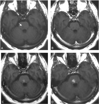 Fig. 5 Non‐enhanced T1‐weighted image (A) of a 61‐year‐old patient displays a hypointense brainstem infarct (arrow) 5 days after stroke. A corresponding gadolinium‐enhanced T1‐weighted image (B) reveals no signs of blood–brain barrier disruption. Twenty‐four (C) and 48 (D) h after USPIO infusion T1‐weighted images show increasing hyperintense enhancement of the infarcted parenchyma.