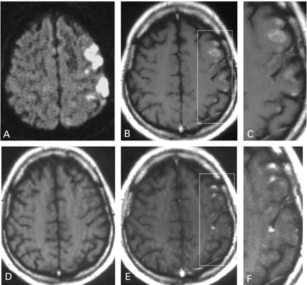 Fig. 6 Images of a 52‐year‐old man with infarction within the left middle cerebral artery territory. A diffusion‐weighted image (A) displays the ischaemic area 2 h after symptom onset. The non‐enhanced T1‐weighted image obtained 5 days later (D) shows slight hypointensity in the corresponding infarction. The spatial distribution of hyperintensity on the USPIO‐enhanced images (B and C) is clearly different from the distribution on gadolinium‐enhancement (E and F). (C and F) Representations of high magnification images of left parietal cortical and subcortical regions as outlined in B and E.