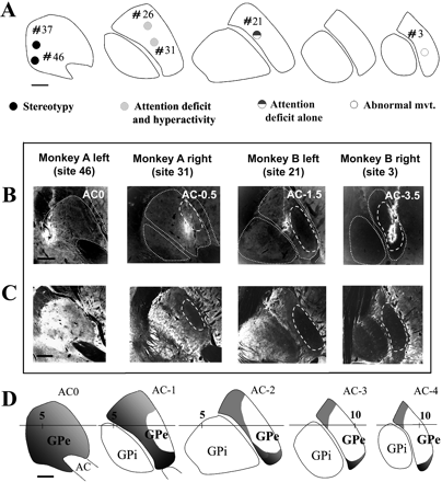 Series of anteroposterior sequences of regularly interspaced transverse sections located with reference to the anterior commissural reference point (AC) and centred on the pallidum. (A) Localization of sites of bicuculline microinjections within the GPe that produced the most characteristic behavioural changes and that were chosen to perform injections of axonal tracer. These pallidal sites elicited either stereotyped behaviour, or hyperactivity with attention deficit, or attention deficit alone, or abnormal movements. (B) Dark-field photomicrographs of axonal tracer injections into four different cases (monkey A, left and right hemisphere, monkey B left and right hemisphere). (C) Dark-field photomicrographs of Cb-immunoreactive material. The distribution of immunoreactivity was directly compared with the delineation of the functional territories of the striatopallidal complex (D) obtained by superimposition of data from tracing studies in the literature (Parent et al., 1984; Smith and Parent, 1986; Haber et al., 1990; Saint-Cyr et al., 1990; Hedreen and DeLong, 1991; Hazrati and Parent, 1992; Flaherty and Graybiel, 1994; François et al., 1994a) onto the same anteroposterior sequence of transverse sections. The sensorimotor territory is represented in white, the associative territory in grey and the limbic territory in black. AC = anterior commissure; GPe = external globus pallidus; GPi = internal globus pallidus.