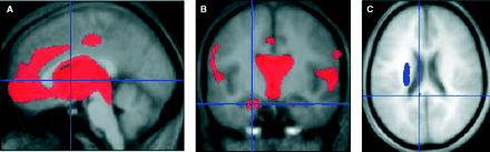 Representative results from VBM analysis. Red indicates areas of decreased grey matter density. Blue indicates areas of decreased white matter density. Images thresholded at FDR P < 0.01 (grey matter) and FDR P < 0.05 (white matter) (A) septal nuclei, diagonal band of Broca, nucleus basalis of Meynert (−2 4 2), (B) bilateral hippocampal formation (−21 −11 −22) and (C) medial pathway (−8 −41 21) (lateral capsular pathway abnormality also visible).
