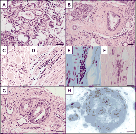 Inflammatory aspects of the autopsied patient. (A and B) Lymphocytic infiltration at parotid gland (A) and submandibular gland (B). Haematoxylin-eosin stain. Scale bar = 40 µm. (C and D) Lymphocytic infiltration at the L4 dorsal root ganglions on axial section (C), and on longitudinal section (D). Haematoxylin-eosin stain. Scale bar = 20 µm. (E and F) Longitudinal section of the median nerve. Perivenular lymphocytic infiltrates in the endoneurium. Klüver–Barrera's stain (E) and UCHL-1 positive cells (F). Scale bar = 20 µm. (G and H) Chronic vasculitis in the perineurial space. (G) Median nerve. Haematoxylin-eosin stain. (H) Sural nerve. Toluidine blue stain. Scale bar = 20 µm.
