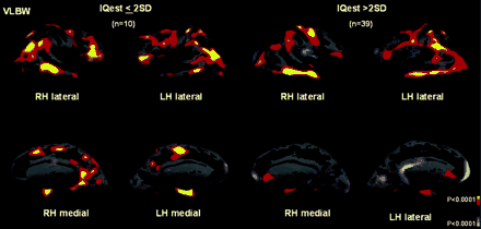 Statistical maps showing areas of significant differences in cortical thickness between the 58 control subjects and the VLBW adolescents subgrouped according to IQest scores. The colour scale shows the dynamic range of changes, yellow represents statistically significant thinning (P < 0.0001), whereas light blue represents statistically significant thickening (P < 0.0001).