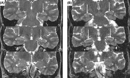 In BVL patients, a 16.91% volume loss in the hippocampus (arrows) was observed in comparison to age- and sex-matched controls (normal hippocampus: dotted arrows). Volume loss was similar for the left and right hippocampus. Analysis of variance (ANOVA) with BVL status and sex confirmed a significant difference in hippocampal volume between BVL patients and controls [F(1, 17) = 13.08]. Shown are examples of coronal 3 mm MRI T2-weighted images with a distance of 6 mm. (A) 39-year-old female volunteer. (B) 40-year-old female BVL patient (for methodological details, see Methods). This patient had a total volume of 3.9 ml (left hippocampus 1939.18 mm3, right hippocampus 2002.82 mm3).