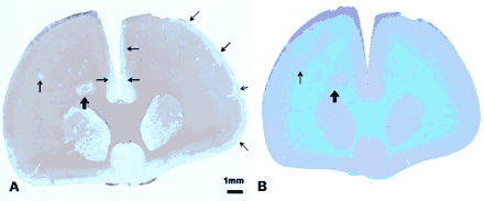 Comparison of immunohistochemical and conventional staining methods. Sequential sections from Case 3 scanned using a flatbed scanner. (A) Section stained using immunohistochemical method with anti-PLP + haematoxylin counterstain. This section shows clearly demarcated white matter (thick arrow) and cortical lesions (thin arrows). Note the presence of bilateral, large subpial lesions starting in the midline immediately above the corpus callosum which in the left hemisphere extends for the entire length of the cortical ribbon. (B) Section stained with conventional methodology using LFB + cresyl violet counterstain. Numerous white matter lesions can be clearly seen using this method but lesions in the cortex, particularly those in the superficial cortical layers are difficult to distinguish from normal myelinated cortex.