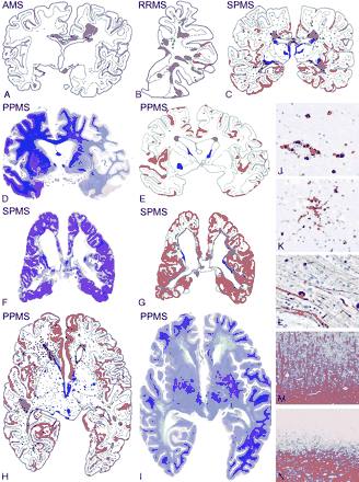 Focal inflammatory demyelinated plaques in the white matter dominate the pathology in acute and relapsing multiple sclerosis, while cortical demyelination and diffuse white matter inflammation are characteristic hallmarks of PPMS and SPMS. A, B, C, E, G and H: schematic lesion maps of multiple sclerosis brains; green: focal demyelinated plaques in the white matter; red: cortical demyelination; blue: demyelinated lesions in the deep grey matter; dark blue dots: inflammatory infiltrates in the brain; light blue dots in C, E, G and H: inflammatory infiltrates in the meninges. A: AMS: male, aged 35 years, 1.5 months disease duration; B: RRMS: female, aged 57 years, 13 years disease duration; C: SPMS: male, 43 years, 16 years disease duration; D and E: PPMS with severe demyelination in the cortex but only minor disease involvement of the white matter, Luxol fast blue stain and corresponding scheme, ×0.3; F and G: SPMS: female, aged 46 years, 16 years disease duration, showing extensive damage in both cortex and white matter, Luxol fast blue stain and corresponding scheme, × 0.3; H: PPMS: female, aged 55 years, 5 years disease duration; I: diffuse white matter abnormalities in PPMS; only the subcortical myelin is intact; there are only few focal demyelinated plaques (see also H); Luxol fast blue stain, ×0.5; J: inflammation in the NAWM in PPMS; immunocytochemistry for CD8, ×150; K: microglia activation and formation of microglia nodules in the NAWM of PPMS, ×75; L: diffuse axonal injury, reflected by axonal swellings and end bulbs in the NAWM of PPMS, immunocytochemistry for neurofilament, ×150; M: normal cortical myelin in a patient with SPMS; immunocytochemistry for PLP, × 12; N: adjacent cortical area to that shown in M with complete demyelination in the entire cortex; myelin in the subcortical white matter is intact; immunocytochemistry for PLP, ×12.