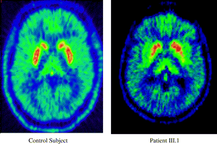 18F-dopa PET scans showing nigrostriatal dysfunction in Patient III.1 (Fig. 1) and a healthy control.