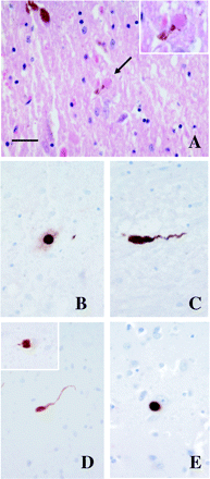 Histopathology of Patient III.13 (Lincolnshire kindred, Fig. 1). In the substantia nigra there was very severe loss of pigmented neurons with small numbers of Lewy bodies [arrow and insert (A)]. Lewy bodies (B) and Lewy neurites (C) were identified in the substantia nigra using α-synuclein immunohistochemistry. Similarly there were small numbers of Lewy neurites (D) and occasional Lewy bodies [inset in (D)] in the olfactory bulb. Lewy bodies were scanty in the neocortex (E). Bar represents 28 µm in (A–E) and 18 (μm in the insert in (A). (A): H&E; (B–E): α-synuclein immunohistochemistry.