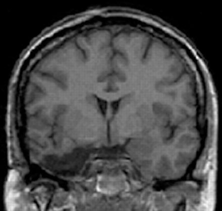 MRI (coronal view) of a representative patient with a right anteromedial temporal resection at the level of the amygdala.