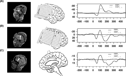 Individual intracranial data: in the MRIs, implanted electrodes become observable as artefacts (left column), and the electrode(s) selected for analysis are marked by white arrow(s). In the middle column, the schematic electrode placement of the individual is presented and selected electrodes are indicated by a filled circle. In the right column, the ERPs at the specified position(s) are depicted; for clarity only two ERPs are shown per individual; each row represents a data set of one individual: (A) temporal N100 of Patient 110, (B) fronto-central N100 of Patient 120, and (C) frontal interhemispheric N100 of Patient 128 (ERP1 versus ERP2…5).