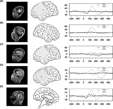Individual data on the effects of tone deviation, as compared to ERP of the repeated stimulus (ERP6versus ERP2…5); please note that in this figure the MMN is not illustrated as difference potential; the structure of the figure is the same as in Fig. 1; (A) temporal MMN of Patient 126, (B) temporal MMN of Patient 118, (C) frontal MMN of Patient 126, (D) frontal MMN of Patient 123, (E) frontal interhemispheric MMN of Patient 117.