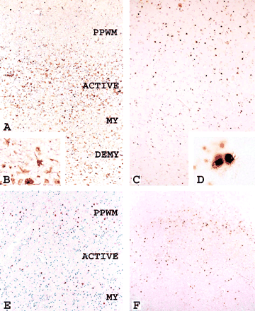 Actively demyelinating lesions in concentric sclerosis. (A) Expression of inducible nitric oxide synthase (iNOS) in the zone of active demyelination (ACTIVE) and to a much lower extent in the periplaque white matter (PPWM) or in the inner layers of myelinated or demyelinated tissue. Magnification ×50. (B) Higher magnification of A depicts iNOS expression in macrophages and microglia. Magnification ×500. (C) HIF-1α is mainly expressed in a small zone of the PPWM, just adjacent to the active edge of the lesion; the active area shows very little HIF-1α-expression, but the outermost layer of preserved myelin again shows a higher density of HIF-1α-positive cells. Magnification ×50. (D) Higher magnification of C demonstrating cytoplasmic expression and nuclear translocation of HIF-1α in small round cells resembling oligodendrocytes. Magnification ×800. (E) Expression of hsp70 in a concentric pattern comparable with that shown for HIF 1α in C. Magnification ×50. (F) A similar pattern of expression is also found for the hypoxia-associated epitope D-110. Magnification ×50.