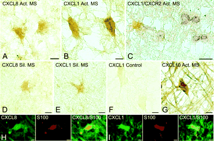 Frozen sections displaying expression of CXC ligands on hypertrophic astrocytes in multiple sclerosis lesions. Immunoperoxidase staining revealed high levels of CXCL8 (A) and CXCL1 (B) on hypertrophic astrocytes in active multiple sclerosis lesions. In C, CXCL1-(brown) expressing astrocytes were found in close proximity to CXCR2- (purple) positive oligodendrocytes at the edge of an active lesion. In contrast, limited staining of CXCL8 and CXCL1 was observed on astrocytes in silent multiple sclerosis (D and E). Lack of non-specific staining is demonstrated by adsorption of the CXCL1 antibody with recombinant human CXCL1 (F). Reactive astrocytes in active multiple sclerosis cases were also strongly positive for CXCL10 (G). The astroglial nature of cells producing CXCL8 (H) and CXCL1 (I) in active multiple sclerosis lesions was confirmed by double immunofluorescence staining with S-100, a marker for reactive astrocytes. Scale bars = 7.5 µm (A, B, D–I); 15 µm (C).