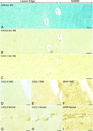 CXC ligands are selectively expressed by hypertrophic astrocytes in active multiple sclerosis lesions. Hypertrophic astrocytes present at the edge of active multiple sclerosis lesions, demonstrated in sections stained by the Luxol fast blue method (A), label positively for CXCL8 (B) and CXCL1 (C). CXC ligands are specifically expressed in regions near the lesion, while there is a lack of CXCL8 and CXCL1 staining in areas of NAWM. In contrast, other than staining blood vessel elements, CXCL8 and CXCL1 were absent in OND (D and E) and normal (G and H) control tissue, despite the presence of GFAP-expressing astrocytes (F and I). Scale bars = 94 µm (A–C); 22.5 µm (D–I).