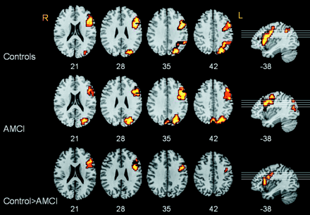 Divided attention task. Group maps depicting areas of significant increase in BOLD signal during the divided attention task for the control group (top) and AMCI group (middle). Both control and AMCI groups activate similar regions in left prefrontal and primary visual cortex. (Bottom) ANOVA (controls > AMCI) indicates a significantly larger activation in the left prefrontal cortex in the control group. The left hemisphere appears to the right of the page. Z-coordinates appear below each axial slice and x-coordinates below each sagittal slice. Lines on sagittal slices correspond to the orientation of the axial slices.