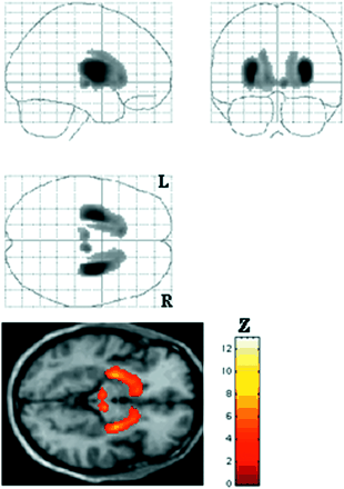 Regions with reduced [11C] RTI-32 binding in the whole group of PD patients compared to controls (P < 0.001, corrected at (P < 0.05). Up: the glass view obtained with SPM99. Down: overlay on a MRI showing the loss of binding bilaterally in the striatum and susbtantia nigra of the patients.