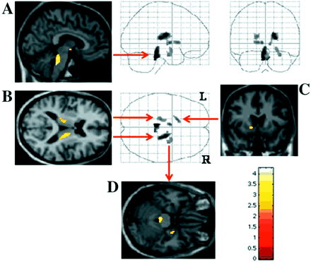 Regions where there is a significant reduction (P < 0.01) of [11C]RTI-32 binding in the depressed compared to non-depressed PD patients. The regions seen in the glass view are shown overlayed on a MRI: (A) locus ceruleus; (B) medial thalamus; (C) left ventral striatum; (D) right amygdala.