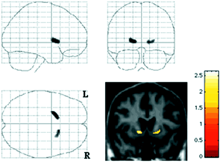 The [11C]RTI-32 binding in the ventral striatum is inversely correlated (P < 0.05) with apathy in the whole group of patients.