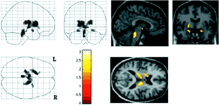 Regions in which anxiety is inversely correlated (P < 0.05) with [11C]RTI-32 binding. Left: SPM99 glassview. Right: overlay on a MRI showing the locus ceruleus (sagittal view), the left ventral striatum and left and right amygdala (coronal view) and the medial thalamus bilaterally and left ventral striatum (axial view).