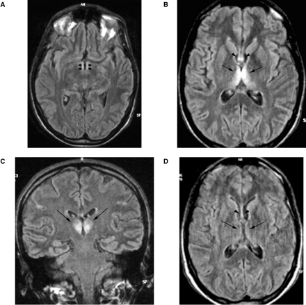 Images from axial and coronal FLAIR sequence of the WK subject. Seven-day MRI study demonstrates signal abnormalities of the mammillary bodies (A) (stars), the medial aspect of the thalami (B, C) (arrows) and the fornix (B) (arrowheads). Five months later signal changes have almost completely disappeared (D) (arrows and arrowheads).