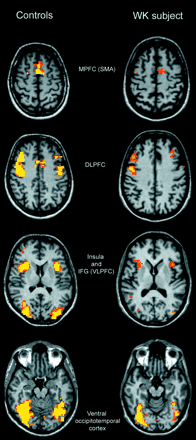 Activated areas during the ‘on’ condition in controls (left column) and the WK subject (right column). Structural and functional images are shown using the right–left radiological convention.