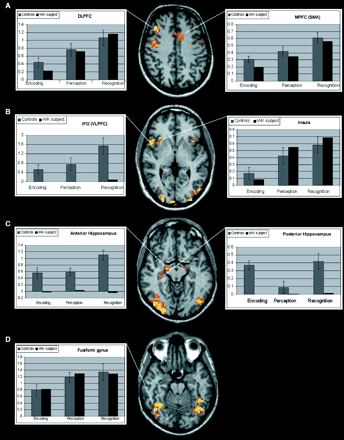 BOLD % signal changes in different cortical regions during task execution in controls and the WK subject. Structural and functional images are shown using the right–left radiological convention. The y axis shows the BOLD % signal change. The error bars represent standard deviations. The comparison between the activations of the control group and the WK subject demonstrates a similar BOLD signal course exept for the hippocampal region and the IFG, where no activation was observed in the WK subject.