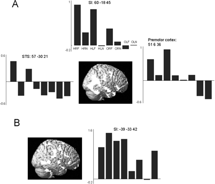 (A) The main effect of observing touch to a human relative to observing touch to an object in the non-synesthetic group resulted in activation of bilateral STS at the temporo-parietal junction, fusiform gyrus, SI, SII and premotor cortex. These activations are shown superimposed on a rendered MR image. Plots show parameter estimates of the relative activation in each of the eight conditions expressed as percentage signal change in right SI, right STS and right premotor cortex. Condition labels as in top plot can be found in Table 1. (B) The main effect of observing touch to a human relative to observing touch to an object in C resulted in activation of the right STS, bilateral SI and SII, insula cortex, left anterior premotor cortex and right cerebellar cortex. These activations are shown superimposed on a rendered image. The plot shows parameter estimates of the relative activation in each of the eight conditions expressed as percentage signal change in left SI.