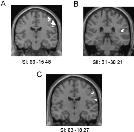 (A) Activations in SI head area resulting from the comparison of observing touch to a human face (relative to a human neck) masked with touch to the subject's face (relative to their neck) in the non-synesthetic group, shown on a coronal section of a T1 image at y = −15. (B) Activations in right SII resulting from the comparison of observing touch to the left side of a human (relative the right side) masked with touch to the subject's left side (relative to their right side) in the non-synesthetic group, shown on a coronal section of a T1 image at y = −30. (C) Activations in SI head area resulting from the comparison of observing touch to a human face (relative to a human neck) masked with touch to the subject's face (relative to neck) in C, shown on a coronal section of a T1 image at y = −18.
