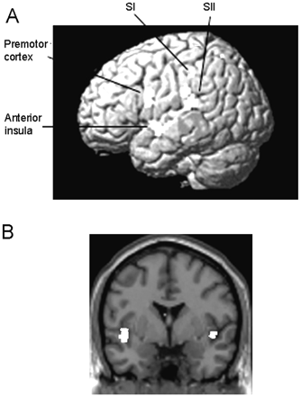 Activations resulting from the comparison between C and the non-synesthetes for the contrast Observation of touch to a human versus observation of touch to an object. (A) Bilateral SI, SII, anterior insula and left premotor cortex were significantly more active in C than in the non-synesthetic group during the observation of touch to a human relative to an object. The left sided-activations are superimposed on a rendered MR image. (B) Bilateral insula activations resulting from this comparison superimposed on a coronal section of a T1 image at y = 0.