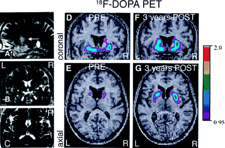 (A–C) MRI study performed 24 h after the first surgery (patient 1). The four parallel needle tracks through the right putamen are visible in the axial (C) and sagittal (A) views (compare with 3D reconstruction of the grafts in Fig. 2D). (D–G) Parametric maps of F-DOPA uptake (Ki) overlaid on the patient's MRI. (D–E) A preoperative PET scan showed a marked, asymmetrical decrease in putaminal18F-DOPA uptake in the first patient, consistent with the diagnosis of idiopathic Parkinson's disease. (F–G) Twenty-eight months after transplantation the PETs show a significant increase in 18F-DOPA uptake, more pronounced in the right putamen (>300% compared with preoperative values) than on the left (100% increase). Ki values are included in Table 1A. R = right; L = left.