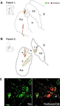 Maps of the dopamine subpopulations, TH/Girk2-positive neurons (red) and TH/Girk2-negative neurons (green) in the putaminal grafts. The maps were generated from representative transverse sections double-immunolabelled for TH and Girk2 using Neurolucida software. Each dot represents one cell. (A, patient 1, and B, patient 2) TH/Girk2-positive neurons were preferentially located in the outer layer of the grafts in the putaminal grafts. (C) Confocal images of triple immunofluorescence studies of TH (green), Girk2 (red) and calbindin (blue) within a putaminal graft (see Table 2 for quantification). Numbers identified the tracks as described in Fig. 3. TH = tyrosine hydroxylase; CB = calbindin; Cd = caudate; Put = putamen; V = lateral ventricle; ic = internal capsule. Scale bar in C, 50 µm.