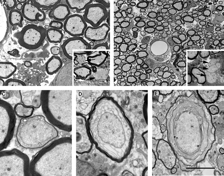 Electron micrographs of the dorsal columns during the first week following LPS injection. (A) A region of the dorsal funiculus 3 days after the injection of LPS. Although for the large majority of axons, myelin is not grossly disrupted at this time, very small numbers of demyelinated axons (arrows in inset) are present. The lack of myelin debris in the extracellular space surrounding these demyelinated axons suggests that the demyelination occurred soon after the injection. The morphology was similar 5 days after LPS injection (B), with the myelin sheaths of most fibres grossly normal but with small regions of cleanly demyelinated axons also present (e.g. arrows in inset). However, 7 days after injection (C, D and E), sheaths exhibiting enlarged adaxonal compartments containing various amounts of lamellar debris were common. Scale bar (shown in E) = 5 µm in A (inset = 10 µm), 25 µm in B (inset = 10 µm), 2 µm in C and D, and 3.6 µm in E.
