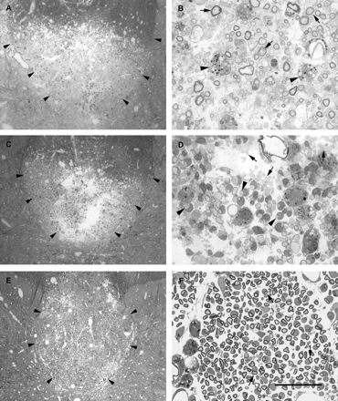 Light micrographs of dorsal funiculi 7 days (A and B), 14 days (C and D) and 28 days (E and F) after the injection of LPS. For each pair of micrographs, the image on the left shows the dorsal funiculus and adjacent grey matter at low magnification and the image on the right shows a region of the lesion at high magnification. In the low-magnification micrographs (A, C and E) the margins of the dorsal funiculus are outlined (arrowheads). At 7 days after injection, most of the deep dorsal funiculus, including all of the corticospinal tract, is undergoing demyelination. B shows a number of axons with disintegrating myelin (arrows), with the lamellae separating either at the adaxonal surface or in midsheath. Several debris-filled macrophages (e.g. arrowheads in B) are present. At 14 days after injection a similar region of lesion is present (C); however, in D it is apparent that the lesion now consists mainly of either apparently naked demyelinated axons (e.g. arrows) or demyelinated axons in the early stages of association with cells (e.g. arrowheads). A number of debris-filled phagocytes are obvious. At 28 days after injection a very large lesion is present, occupying nearly all of the dorsal funiculus. At this time, axons with the signet ring appearance characteristic of Schwann cell remyelination predominate (arrows in F). Scale bar (shown in F) = 300 µm in A, C and E, and 30 µm in B, D and F.
