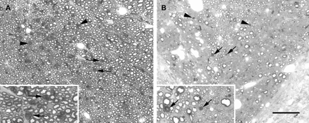 Light micrographs illustrating the extent of Wallerian degeneration occurring within the dorsal funiculus 7 days after the injection of LPS. A shows the region of maximal Wallerian degeneration (e.g. arrows and arrowheads) in the non-corticospinal tract fibres approximately 4 mm rostral to the lesion. The degenerating axons indicated by the arrows in A are shown at higher magnification in the inset. The corticospinal tract approximately 4 mm caudal to the lesion is shown in B, which illustrates that relatively few fibres (arrows and arrowheads) are undergoing degeneration in this region. The degenerating axons indicated by the arrows in B are shown at higher magnification in the inset. Scale bar (shown in B) = 50 µm in the main images, 25 µm in the inset in A and 20 µm in the inset in B.