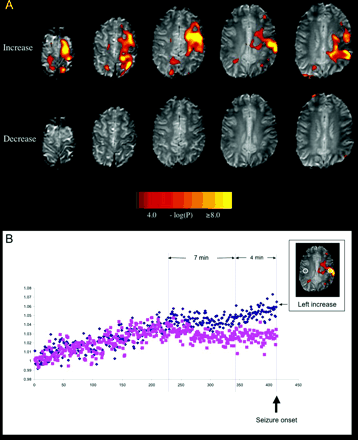(A) Pre-ictal BOLD signal changes in Patient 1. Top row. BOLD signal increases were seen in the left frontal lobe and post-central gyrus. Bottom row. No significant BOLD signal decreases were seen. (B) The time course of the BOLD signal for 25 min prior to a seizure. This was measured in a 25 voxel ROI in the area of maximal BOLD signal. Increase (small image) is shown as diamonds and the BOLD signal in the homologous contralateral region is shown as squares. Image intensity in both regions was normalized to 1 in the first volume (y-axis) and plotted as a function of volume number (one volume every 3.6 s, x-axis). Note the signal fluctuates in a similar way in both regions for the first few minutes, followed by a divergence of BOLD signal 11 min prior to the seizure event, with relatively increased signal in the ROI ipsilateral to the seizure focus. This increase is biphasic, with an initial change maintained for ∼4 min, followed by a progressive increase until the seizure (vertical lines).