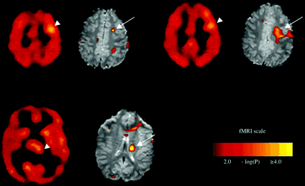 Ictal SPECT and pre-ictal BOLD signal increases in Patient 3 shown at three different levels, with corresponding SPECT images on the left and fMRI images on the right. Top row. Pre-ictal BOLD increases in the left premotor/prefrontal area at the grey–white junction (arrows) correspond with ictal hyperperfusion near these sites with ECD SPECT (arrowheads). Bottom row. Pre-ictal BOLD signal increases (arrow) in the left caudate nucleus, have a similar location to ictal ECD SPECT hyperperfusion (arrowhead).