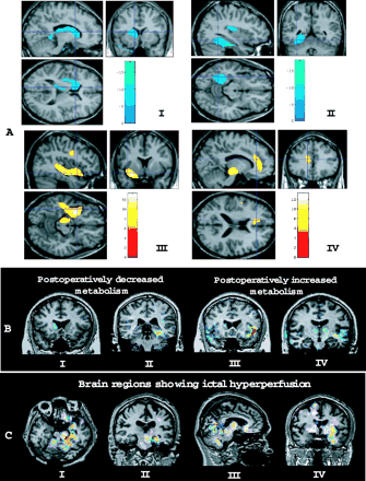 (A) SPM results of pre- and postoperative FDG-PET images. A postsurgical decrease in glucose metabolism was observed in the ipsilateral caudate nucleus, thalamus (I), fusiform gyrus and the posterior region of the insula (II), whereas a postsurgical increase in glucose metabolism was observed in the anterior region of the insula, temporal stem white matter, inferior precentral gyrus, ipsilateral midbrain (III) and anterior cingulate gyrus (IV) ipsilateral to resection (familywise error-corrected, P < 0.05). SPM results were overlaid on the brain MRI of a single normal control. Red-yellow colour means increased metabolism; blue colour indicates decreased metabolism. (B) Subtraction between pre- and postsurgical FDG-PET images in individual patients. I and II show postoperatively decreased glucose metabolism in the caudate nucleus after right temporal lobectomy (I) and in the fusiform gyrus after left temporal lobectomy (II). III and IV show postoperatively increased glucose metabolism in the left anterior insular cortex and small areas of the right anterior temporal region after left temporal lobectomy (III) and in the left temporal stem white matter and midbrain and in bilateral thalami after left temporal lobectomy (IV). (C) SISCOM (subtraction ictal–interictal SPECT co-registered to MRI) result of a patient with left mesial TLE. Ictal hyperperfusion was observed in the left mesial temporal region (amygdala–hippocampus), left midbrain and cerebellum (I∼III), and in bilateral basal ganglia, left anterior insula and left temporal stem white matter (IV).