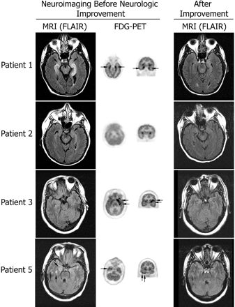 MRI and FDG-PET at symptom presentation and MRI after improvement. Axial MRI FLAIR sequences have been matched with axial and coronal FDG-PET to show the areas of maximal involvement. The same MRI region is shown after symptom improvement. Patient 1 had bilateral medial temporal lobe FLAIR abnormalities that correlated with the areas of FDG hyperactivity; the MRI findings are remarkably improved 4 months later. Patient 2 had mild FLAIR abnormalities in the medial temporal lobes with generalized FDG hypoactivity (attributed to antidepressants); the MRI was normal 3 months later. Patient 3 had bilateral non-specific foci of T2 and FLAIR abnormalities in frontal lobes (not shown) and normal temporal lobe findings; the FDG-PET showed hyperactivity in the left frontotemporal region; follow-up MRI 22 months later was unchanged (non-specific abnormalities in frontal lobes; normal temporal lobes) without evolving atrophy. Patient 5 had mild FLAIR abnormalities in the temporal lobes that predominated in the right side, and correlated with the indicated areas of FDG hyperactivity in the right temporal lobe (FDG hyperactivity was also present in the left cerebellum, not shown); the follow-up MRI 27 months later was normal.