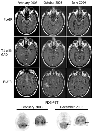 Follow-up MRI and FDG-PET in patient 7. MRI FLAIR sequences and T1 with gadolinium (T1 with GAD) obtained at three time points during the clinical course of patient 7. Note the presence of bilateral medial temporal lobe FLAIR hyperintensities with progressive evolving atrophy (arrows point to the progressive volume loss in the left hippocampus), and transient FLAIR abnormality in the right insula (October 2003). After gadolinium administration (T1 with GAD), there was mild enhancement in the left medial temporal lobe (February 2003) that resolved in the follow-up studies. The FDG-PET obtained in February 2003 showed hyperactivity in the vermis of the cerebellum (arrow) that preceded by 4 months the development of gait ataxia, and hyperactivity in the medial temporal lobes (bilateral arrows in coronal sections) that correlated with the limbic dysfunction and MRI FLAIR abnormalities in the temporal lobes. The FDG-PET in December 2003 shows resolution of the hyperactivity that correlated with transient stabilization of symptoms and decreased CSF pleocytosis after treatment with cyclophosphamide and corticosteroids.